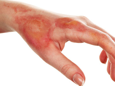 بیشترین علت مراجعه به بیمارستان سوانح و سوختگی گناوه